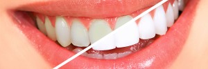 teeth-whitening-facts