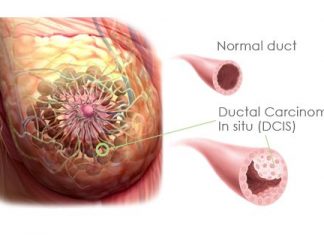 In situ καρκίνος του μαστού: Ο μαστολόγος σας λύνει τις απορίες