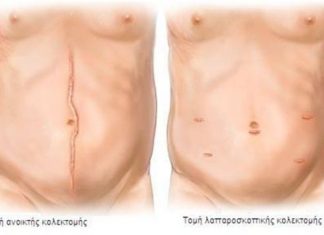 Λαπαροσκοπική κολεκτομή : Η καινοτόμος χειρουργική μέθοδος