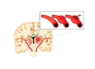 Ανεύρυσμα εγκεφάλου και αδένωμα υπόφυσης – Συμπτώματα & Θεραπεία