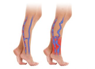 Κιρσοί κάτω άκρων – Πώς να τους θεραπεύσετε με σκληροθεραπεία