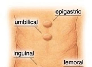 Τι είναι οι κήλες και πως θα τις αποφύγετε